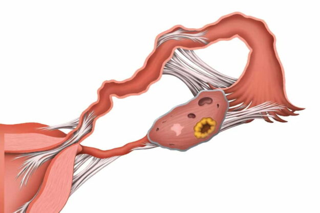 neprohodimost-matochnyh-trub-2x