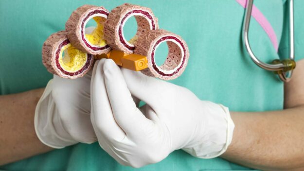 атеросклероз