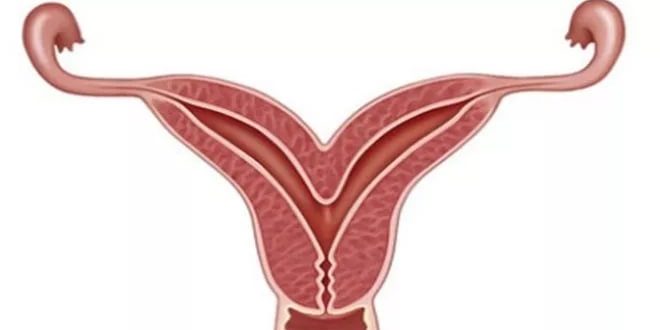 двурогая матка 1