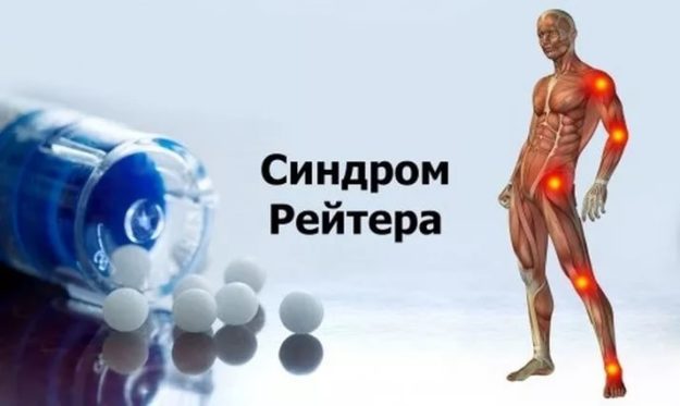 синдром рейтера