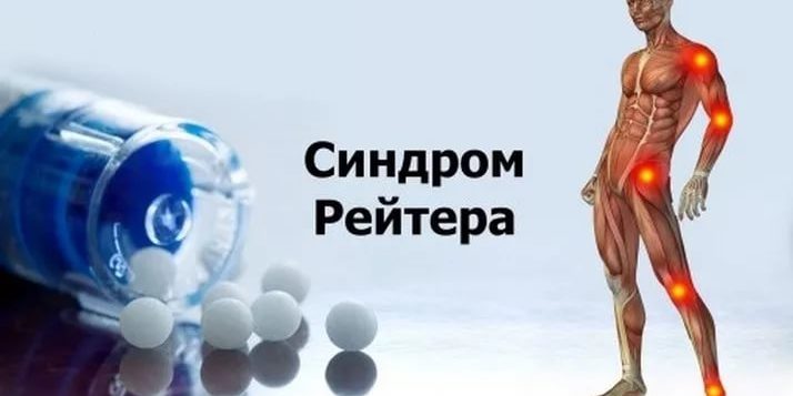 артрит синдром рейтера этим
