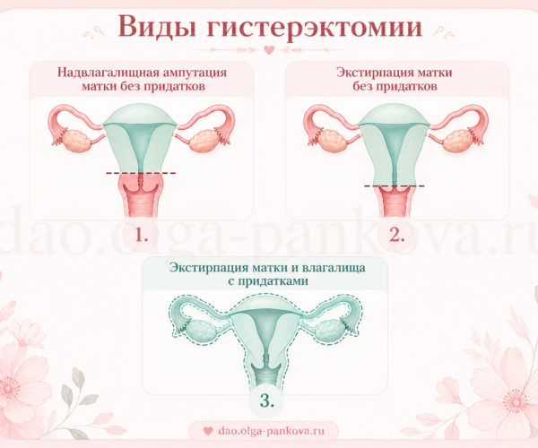 виды гистерэктомии виды гистерэктомии