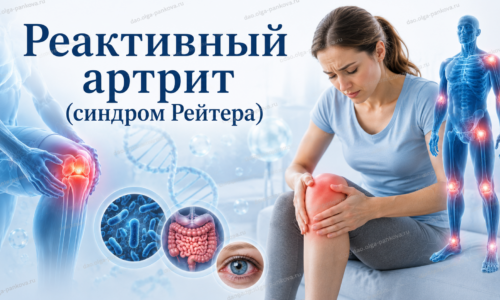 реактивный артрит рейтера