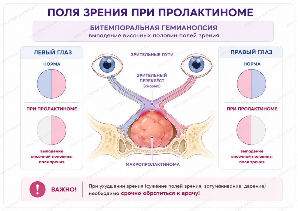 пролактинома поля зрения